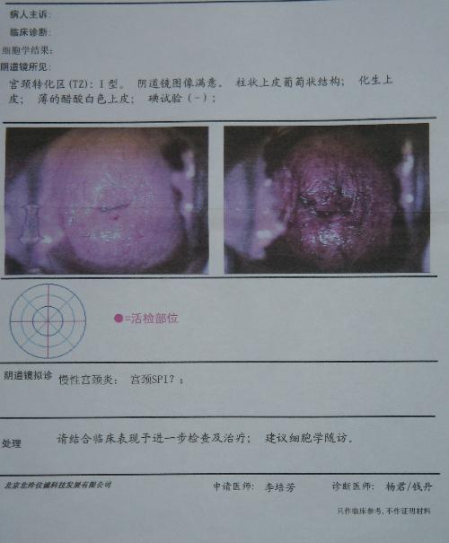 宫颈糜烂最新手术治疗，进展与前景展望